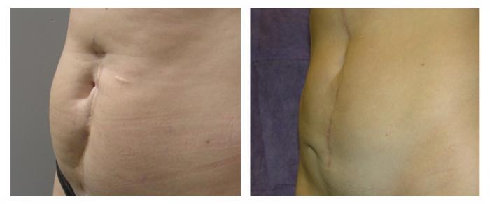 tattoo removal scars. Scar and Tattoo Removal