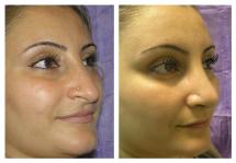 Rhinoplasty photos before and after