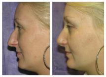 Rhinoplasty photos before and after 2 weeks