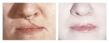Иссечение рубца верхней губы - фотография до и после