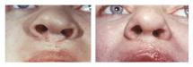 Congenital cleft lip - reconstructive cheiloplasty and rhinoplasty