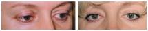 Blepharoplasty - Eye Lids and Eye Bags Plastic Surgery photo