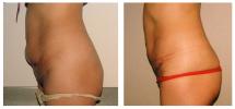 Mini Tummy Tuck - before and 2 weeks after