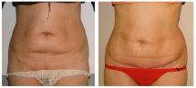 Mini Tummy Tuck - before and 2 weeks after
