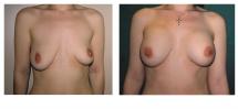 Αυξητική στήθους και διόρθωση της ασυμμετρίας μαστού φωτογραφίες - Πριν και Μετά