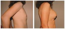 Αυξητική στήθους φωτογραφίες - Πριν και Μετά