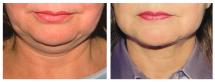 Neck Lift - photo before and after