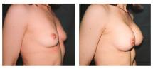 Breast Augmentation - before & after photos