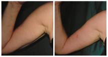 Arm lift - Brachioplasty - before and after photo