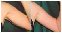 Arm lift - Brachioplasty - before and after photo