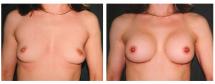 Breast Augmentation - before & after photos
