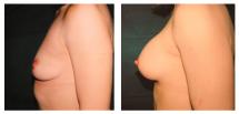 Αυξητική στήθους φωτογραφίες - Πριν και Μετά
