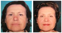 Botox injections - before and after