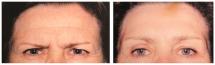Botox injections - before and after