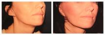 Подтяжка лица - фото до операции и 2 недели спустя 