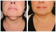 Chin Liposuction - photo Before & After