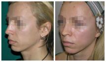 Face lift before and after photos
