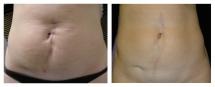 Removal of postoperative scar on abdomen - photo before and after