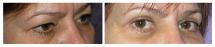 Blepharoplasty and xanthelasma - Eye Lids and Eye Bags Plastic Surgery photo