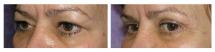 Blepharoplasty and xanthelasma - Eye Lids and Eye Bags Plastic Surgery photo