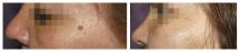Removal of nevus - photo before and after 10 days