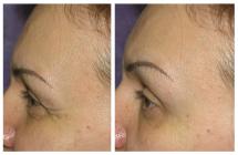 BOTOX photos before and after