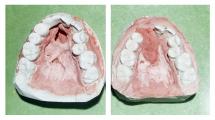 Cleft of the hard palate - Reconstructive Surgery - Before and After