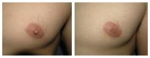 Male Nipple Reduction - Before and After