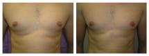 Male Nipple Reduction - Before and After