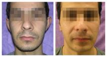 Otoplasty - photo Before and After
