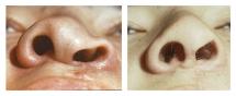 Reconstructive cheiloplasty rhinoplasty after congenital cleft lip. Before After