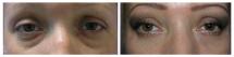 Blepharoplasty - Eye Lids and Eye Bags Plastic Surgery photo