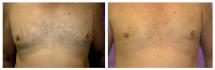 Gynecomastia reduction - photos before and after