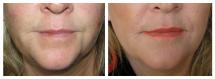 before and after Restylane injections