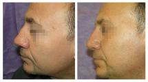 Rhinoplasty photos before and after