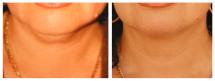 Ανόρθωση λαιμού φωτογραφίες - Πριν και Μετά