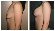 Αυξητική στήθους και διόρθωση της ασυμμετρίας μαστού φωτογραφίες - Πριν και Μετά