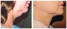 Ανόρθωση λαιμού φωτογραφίες - Πριν και Μετά