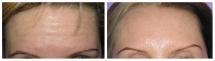 Botox photos - Before and After