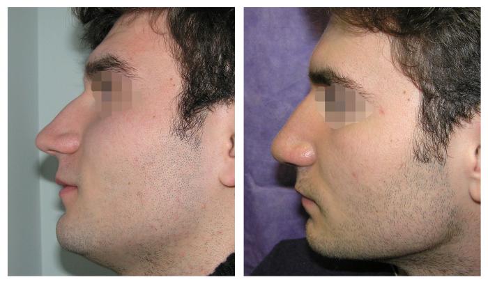 Рост носа в год. Ринопластика Кавказского носа. Уменьшение кончика носа у мужчин. Ринопластика кончика носа мужчинам.