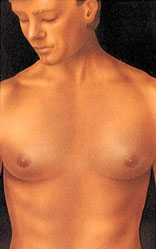 Gynecomastia male breast reduction